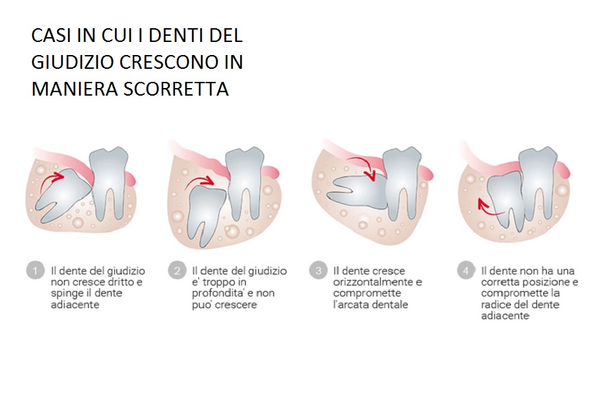 Denti del giudizio crescono in maniera errata