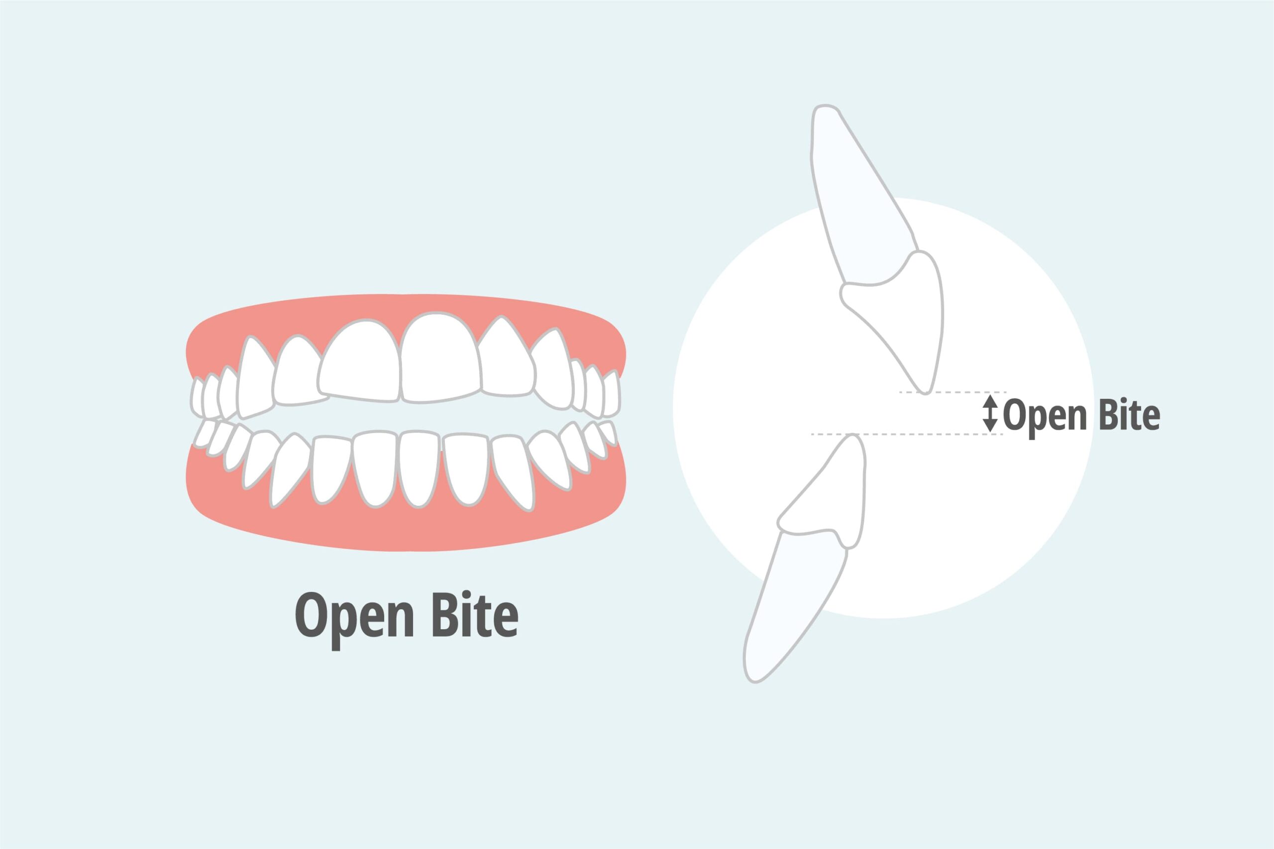 open bite