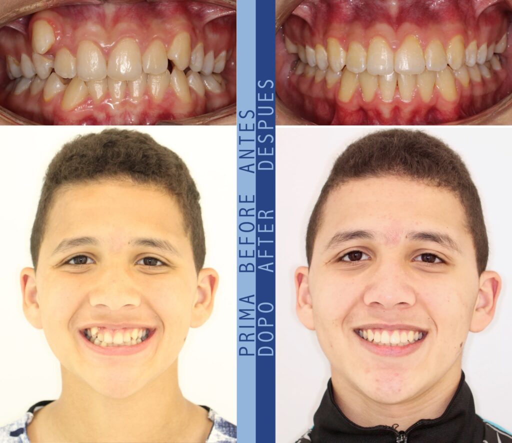 AMINE prima e dopo