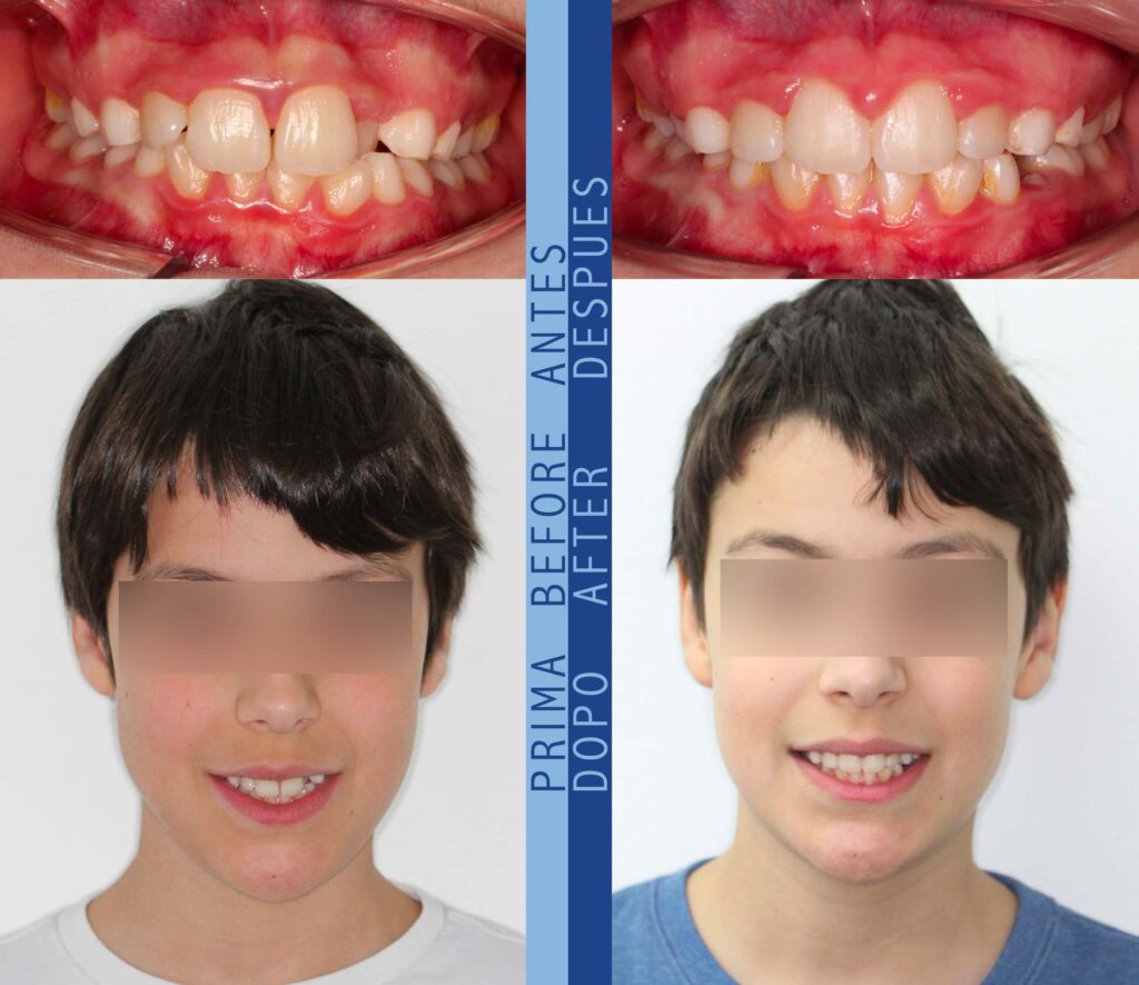 Niel prima e dopo