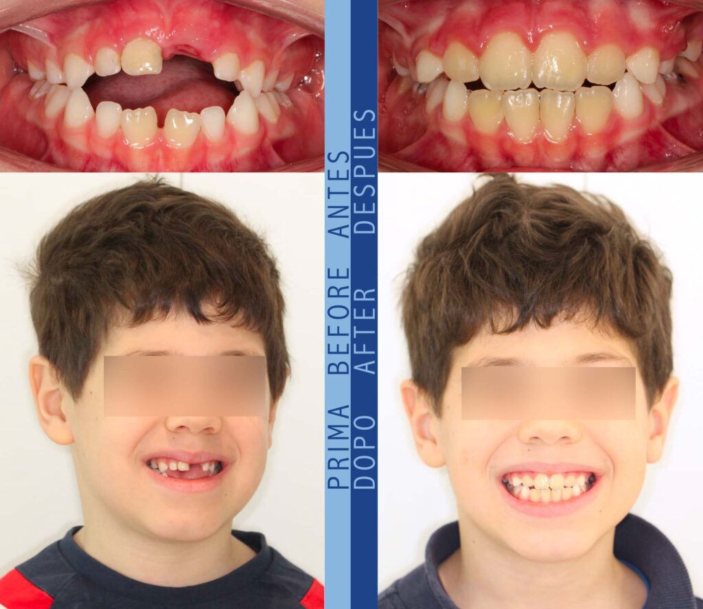 Samuele prima e dopo