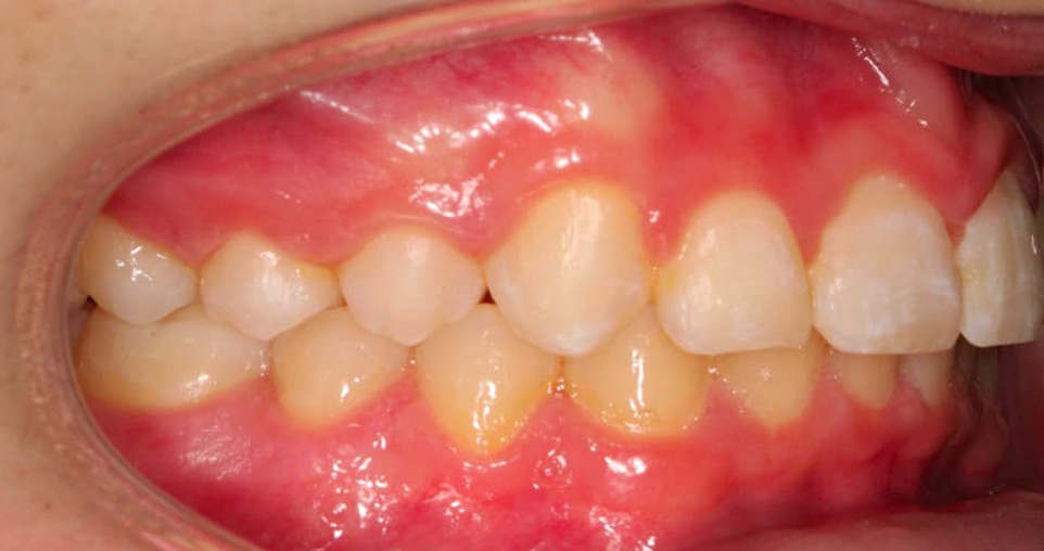Andrea sorriso dopo dentista varese