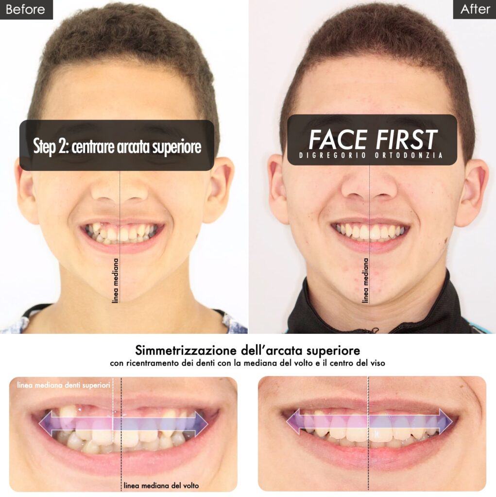 face fist esempi di sorrisi prima e dopo ortodonzia Varese